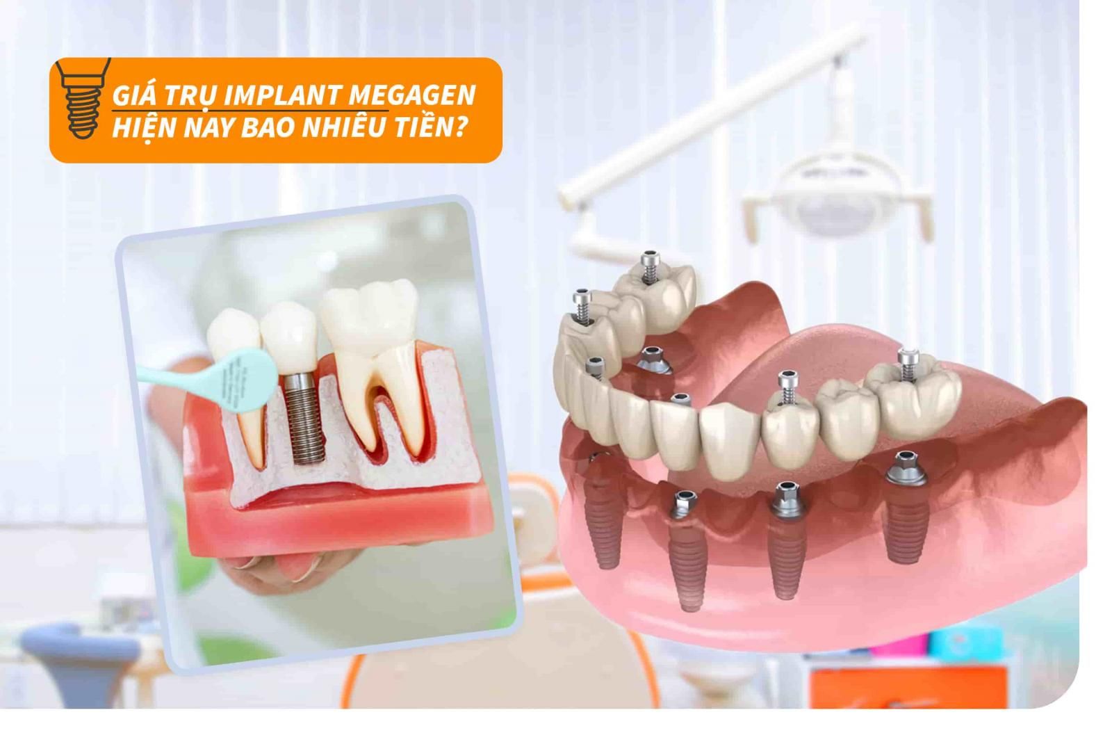 Giá của trụ Implant Megagen hiện nay