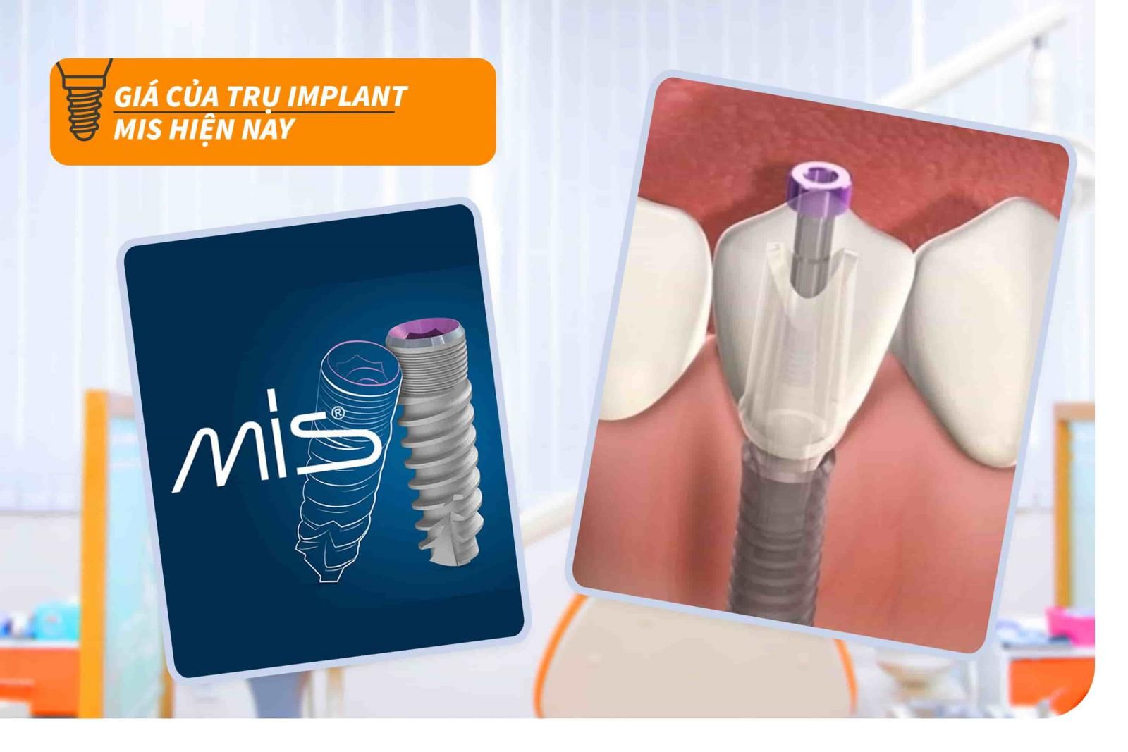 Giá của trụ Implant MIS hiện nay