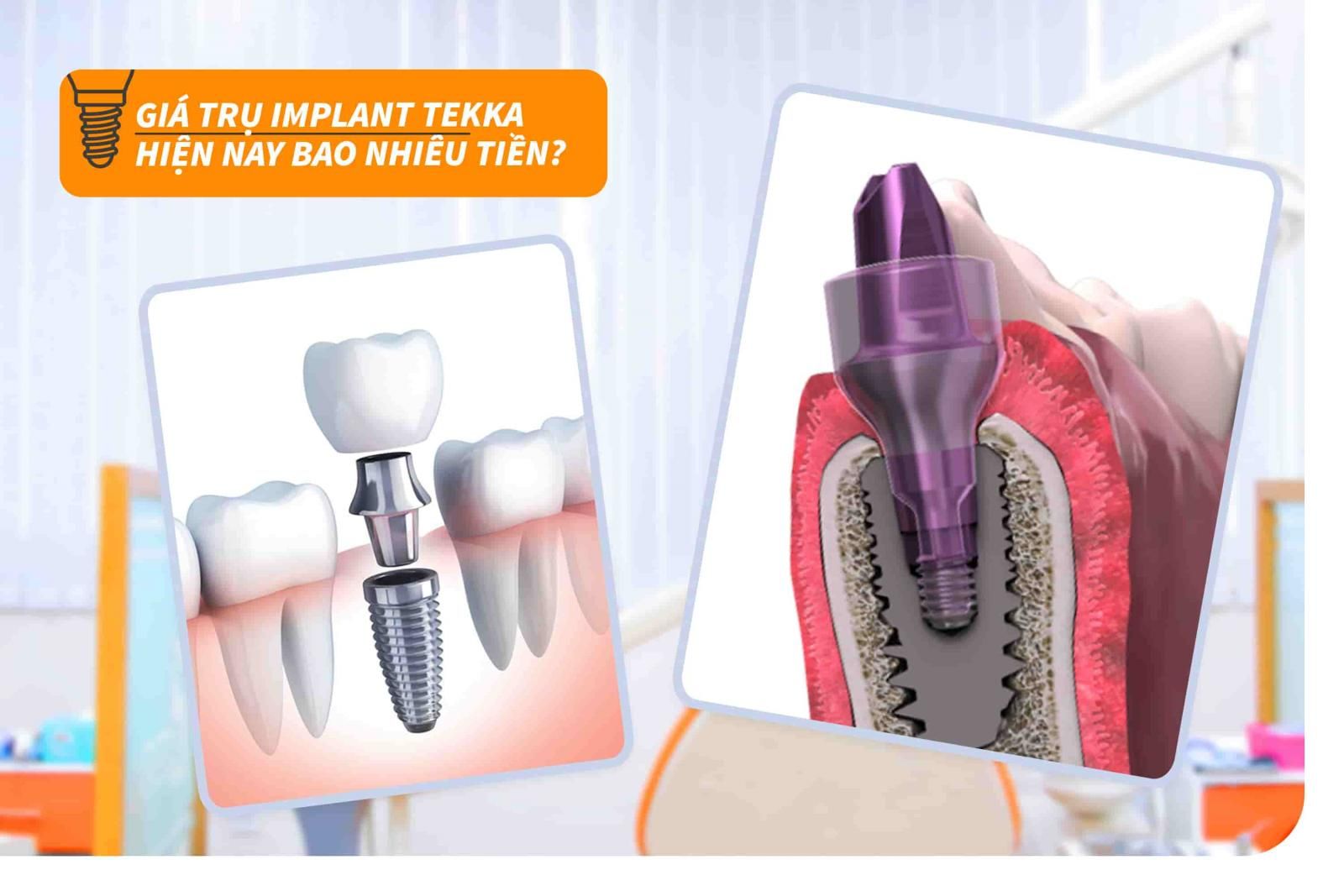 Giá trụ Implant Tekka hiện nay