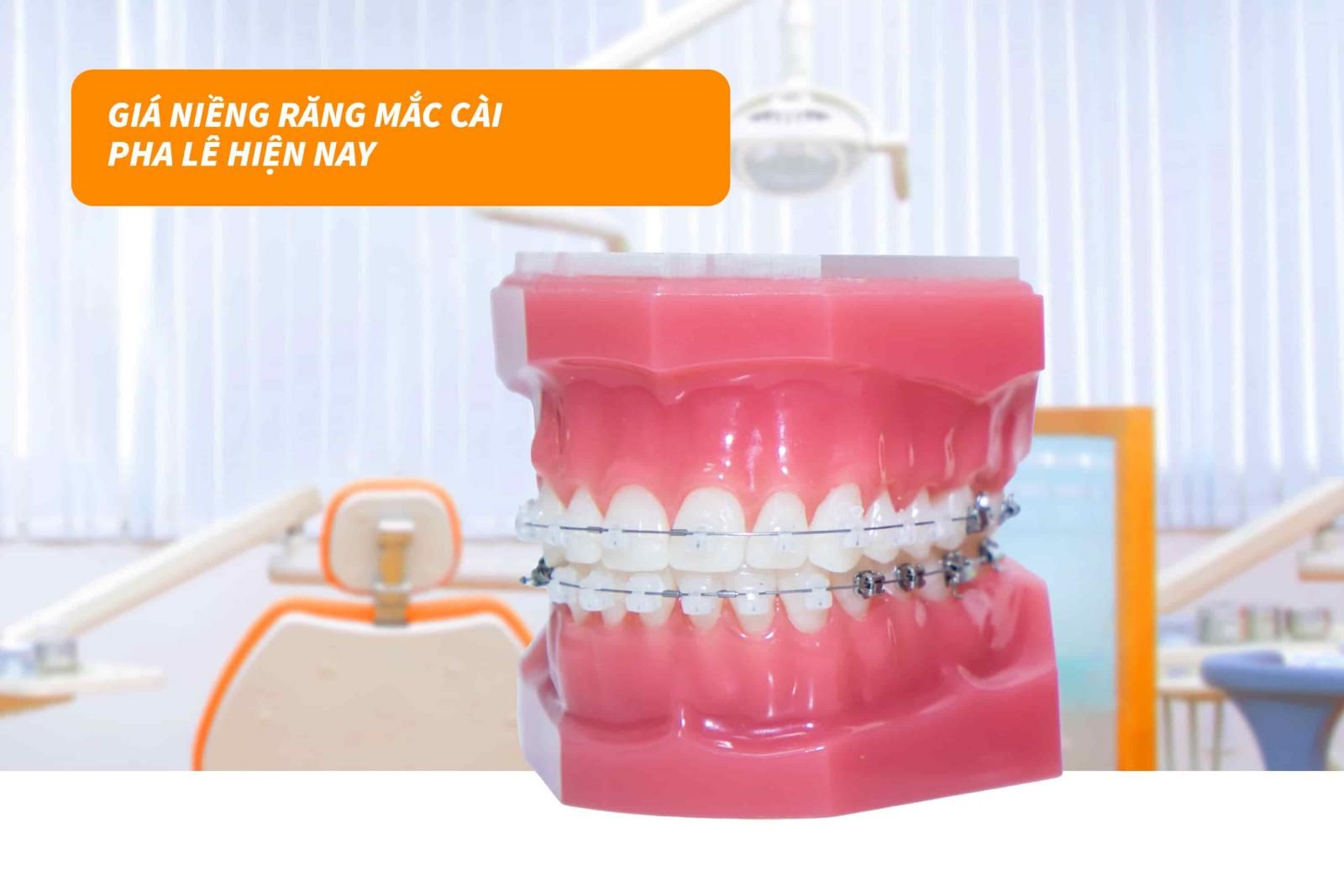 Giá niềng răng mắc cài pha lê hiện nay