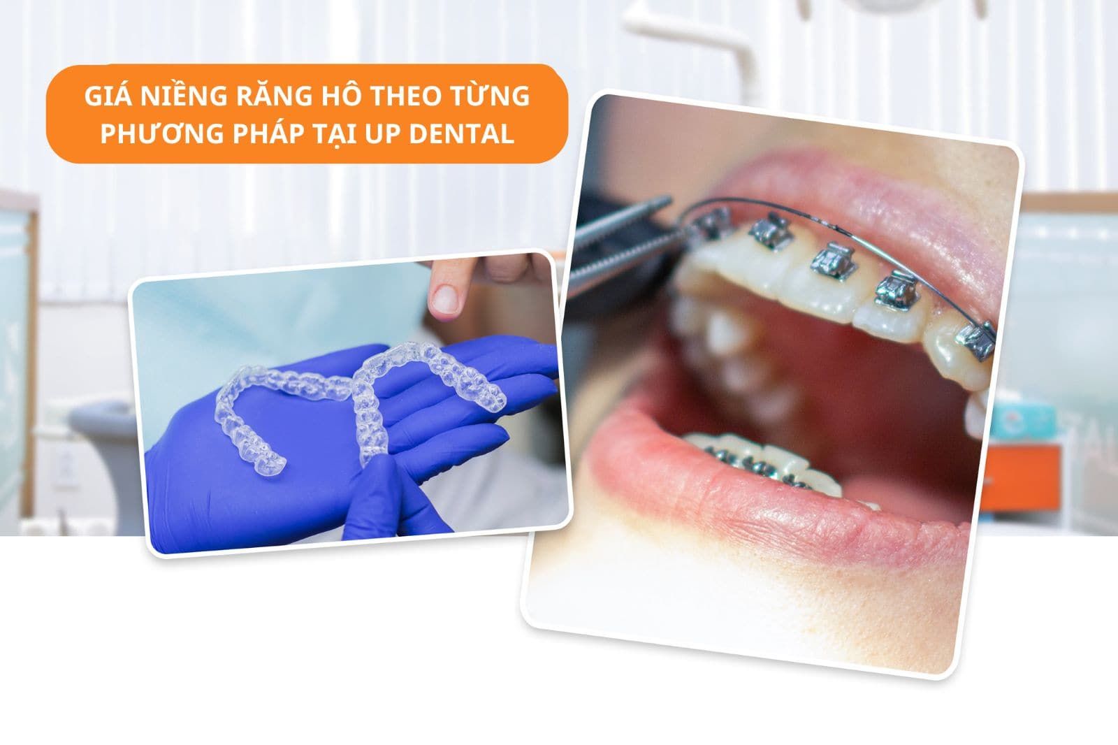 Giá niềng răng hô tại Up Dental bao nhiêu tiền?