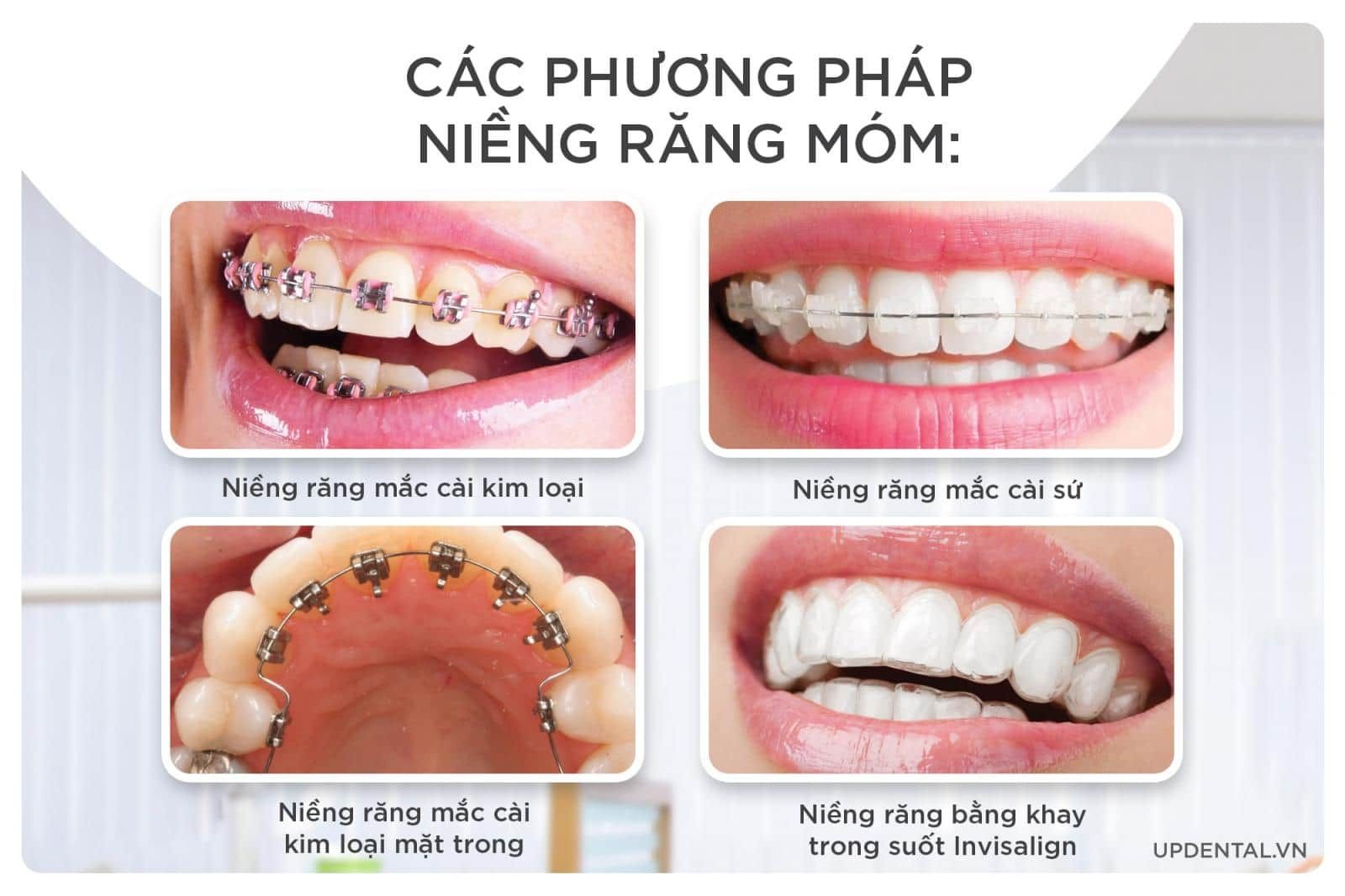 Giá niềng răng móm mới nhất tại Up Dental