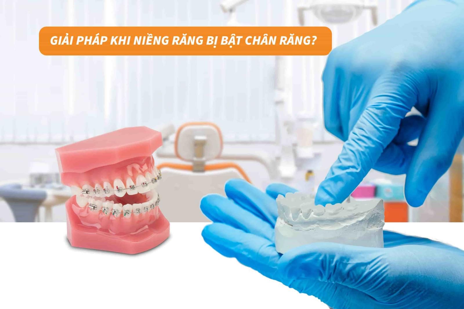 Giải pháp khi niềng răng bị bật chân răng