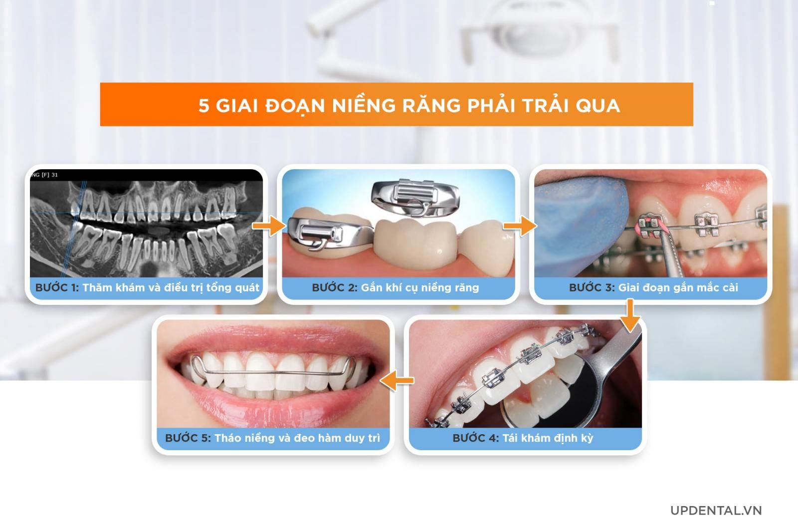 5 giai đoạn niềng răng phải trải qua