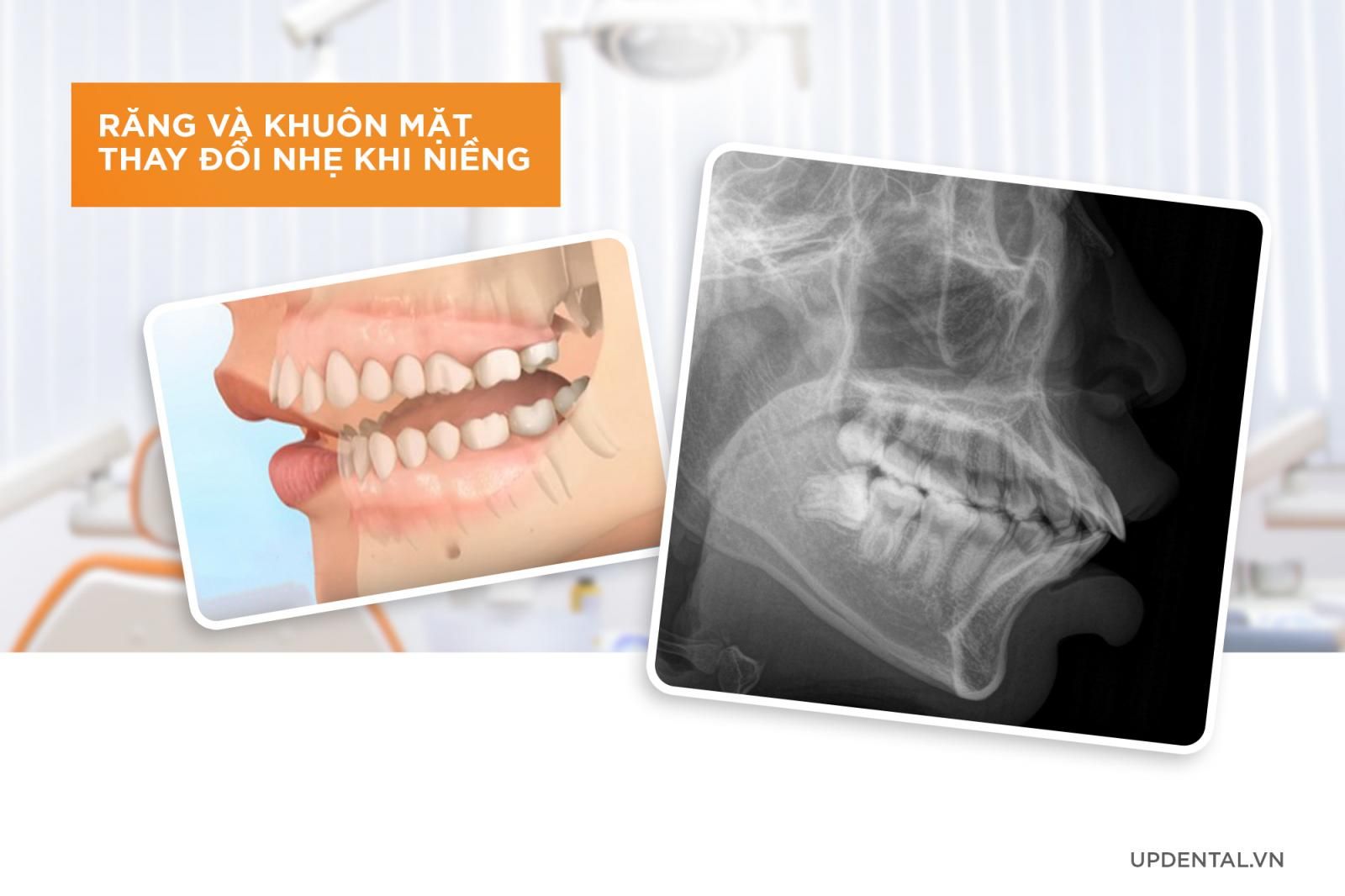 răng và khuôn miệng thay đổi nhẹ khi niềng