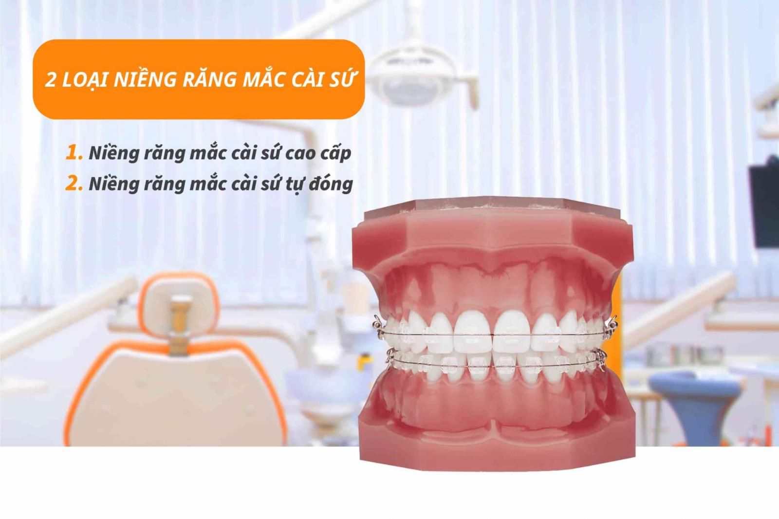 Niềng răng mắc cài sứ 