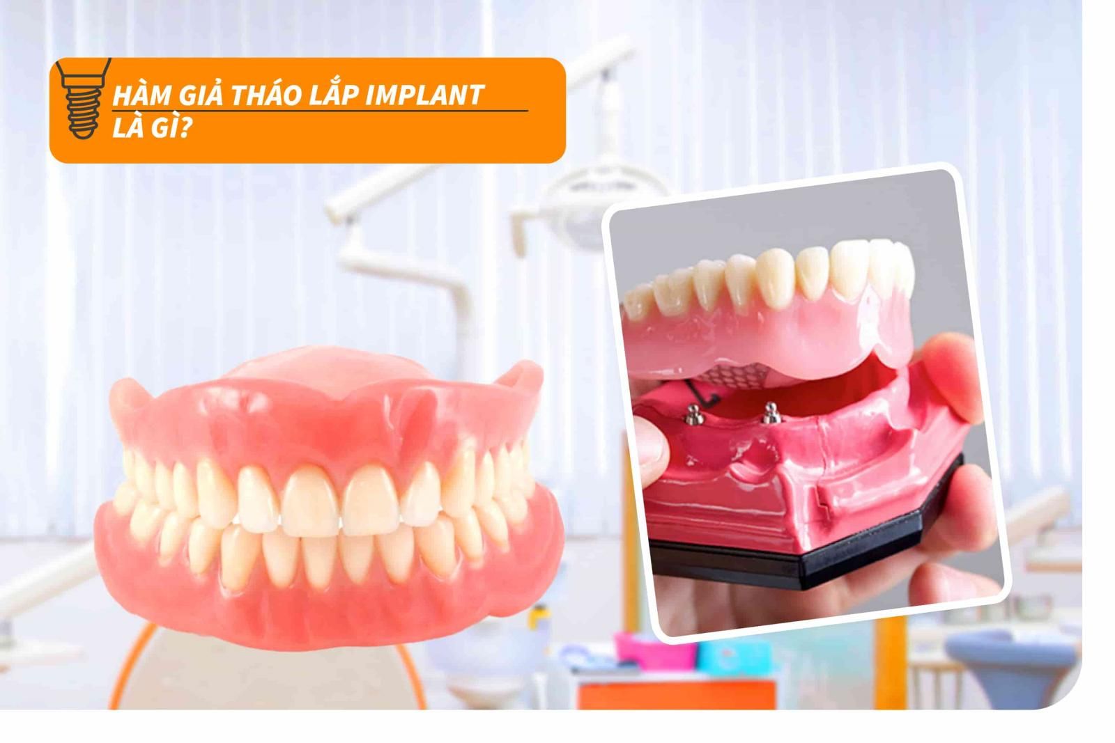 Hàm giả tháo lắp Implant là gì?