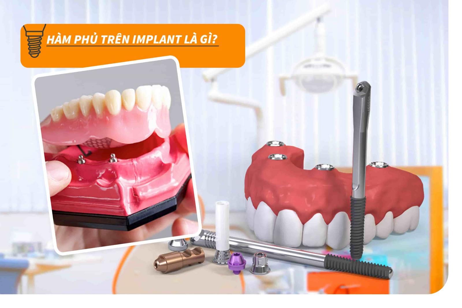 Hàm phủ trên Implant là gì?