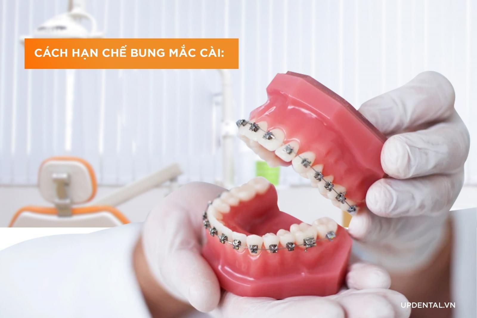 phải làm gì để hạn chế bung mắc cài khi niềng răng