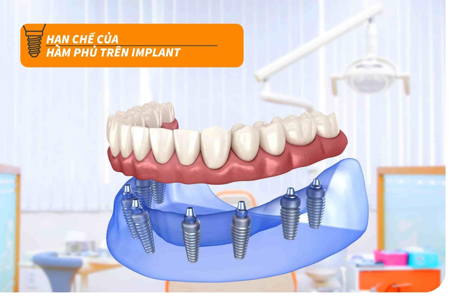 Hạn chế của hàm phủ trên Implant