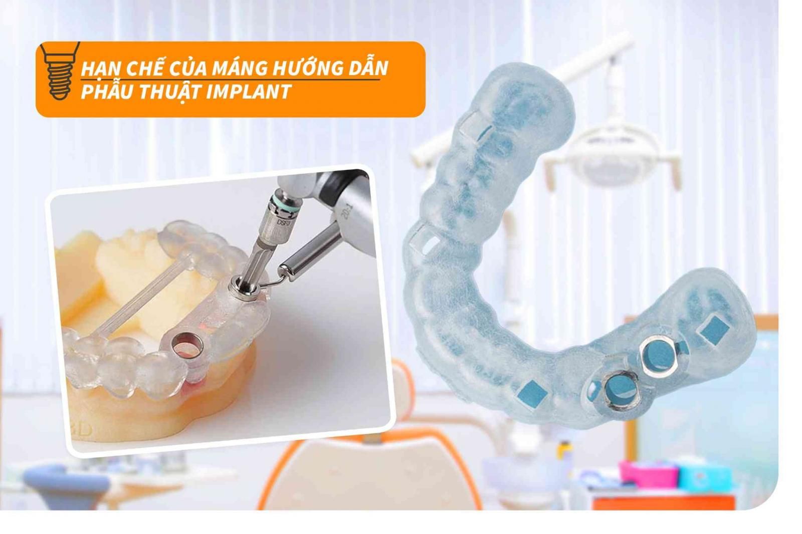 Hạn chế của máng hướng dẫn phẫu thuật Implant