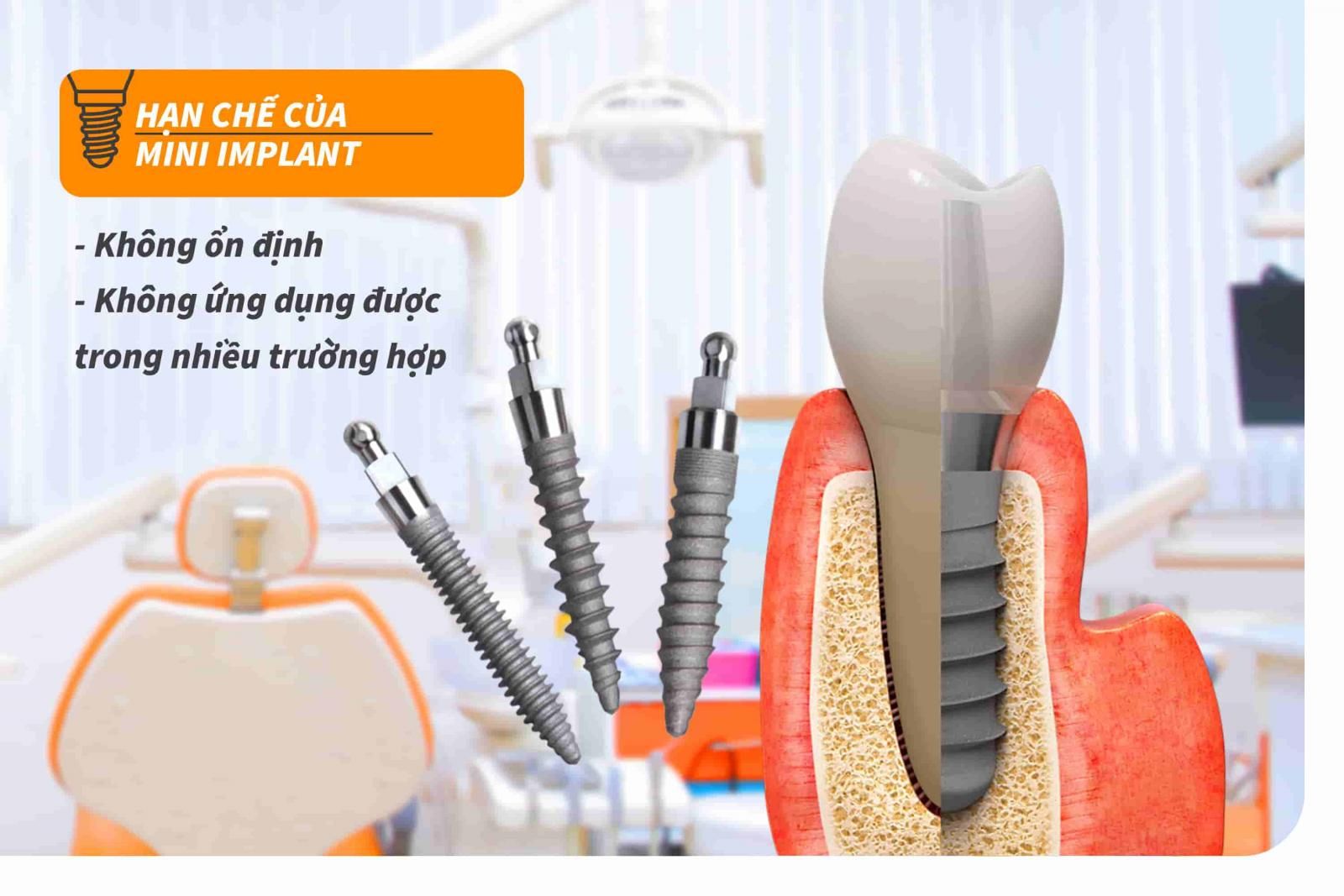 Hạn chế của mini Implant