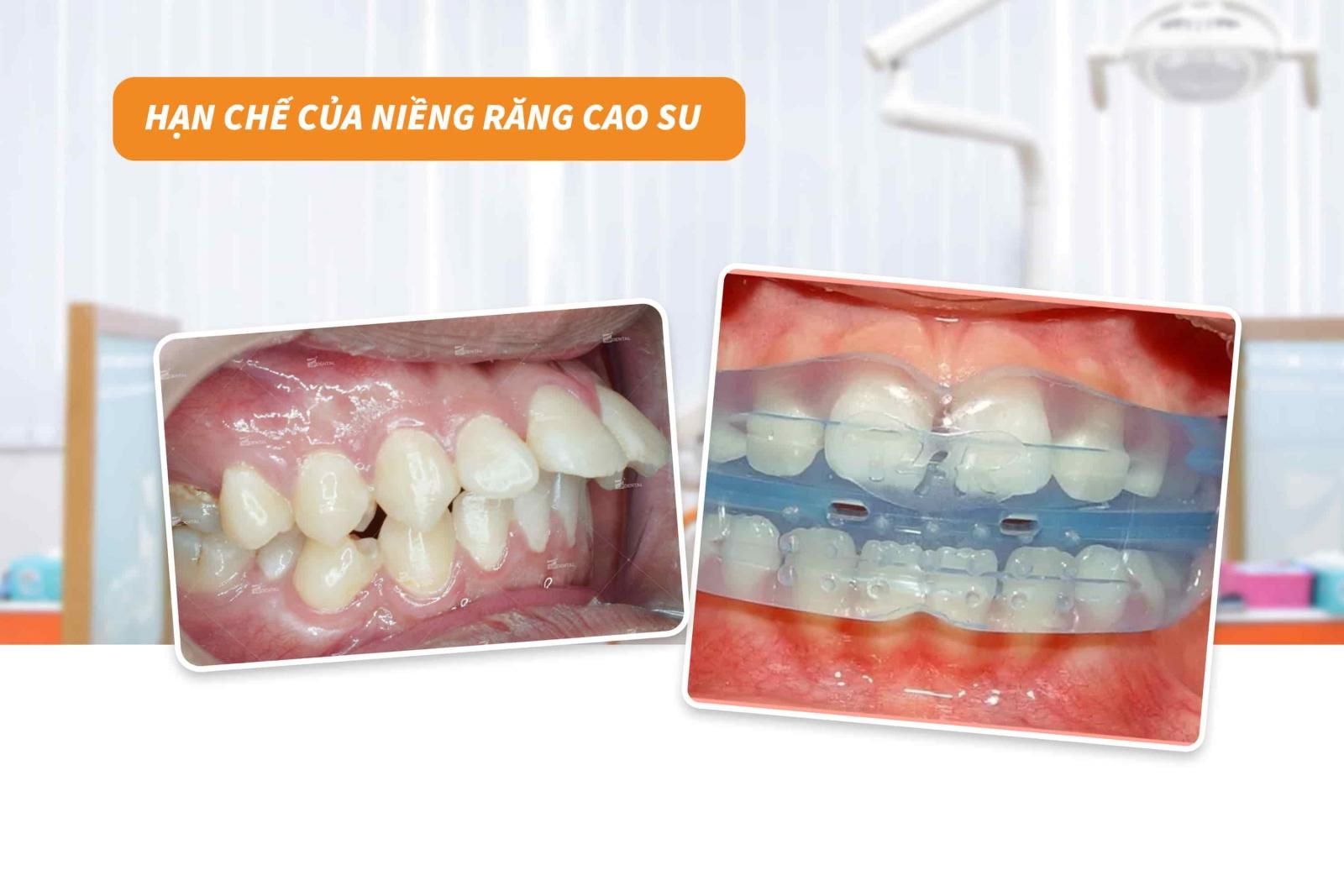 Hạn chế của niềng răng cao su