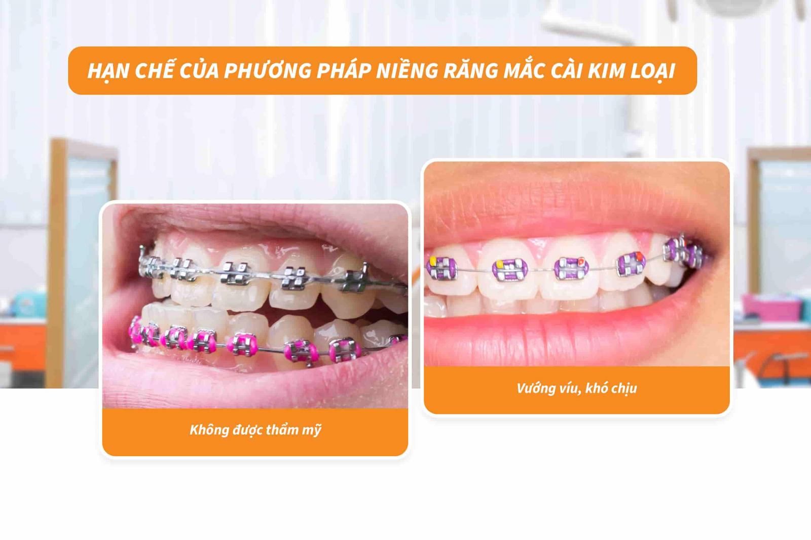 Hạn chế của phương pháp niềng răng mắc cài kim loại