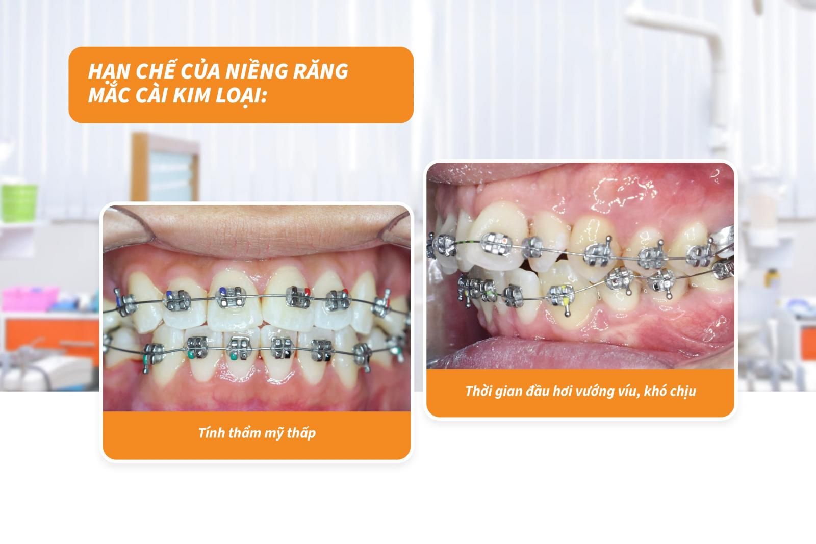 Hạn chế của niềng răng mắc cài kim loại