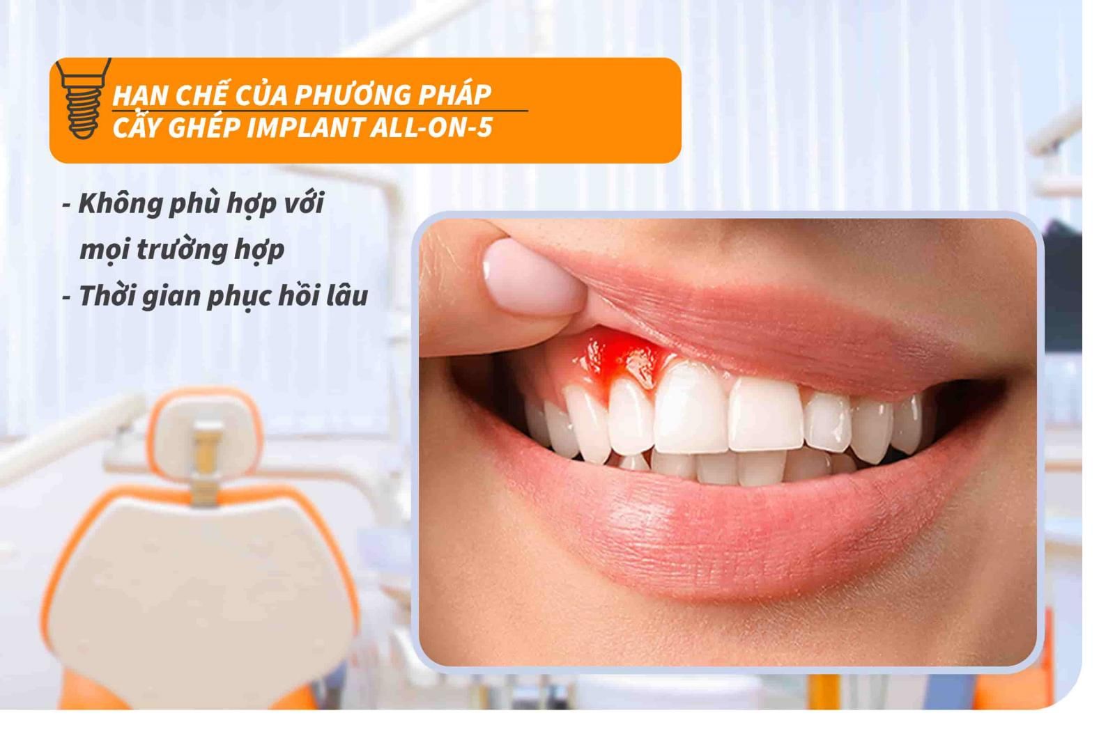 Hạn chế của phương pháp cấy ghép Implant all-on-5