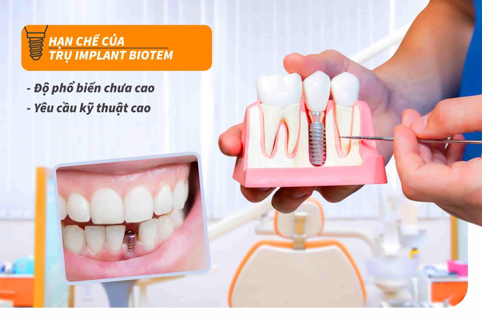 Hạn chế của trụ Implant Biotem