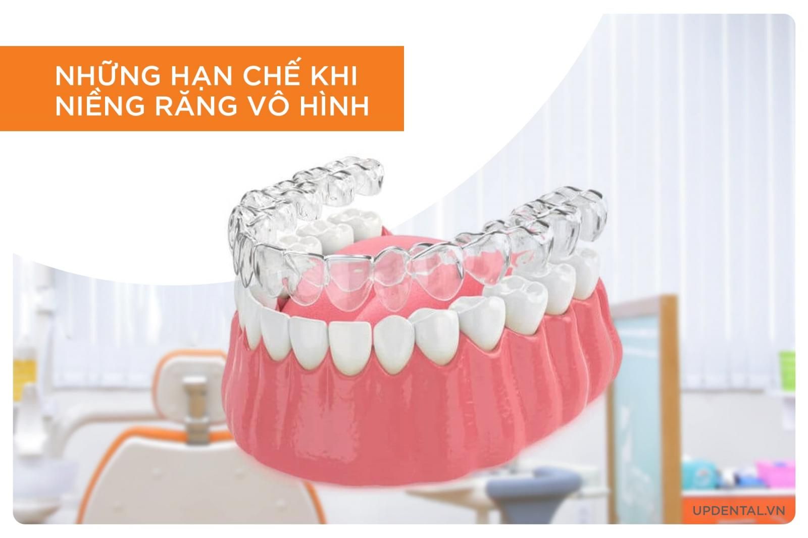 hạn chế của niềng răng vô hình