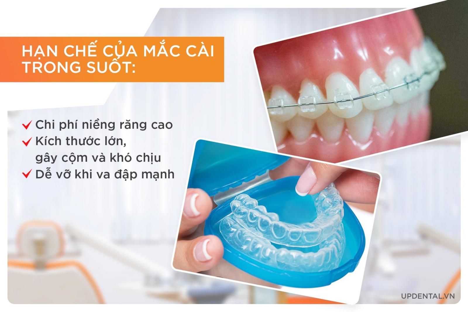 Hạn chế của niềng răng mắc cài trong suốt