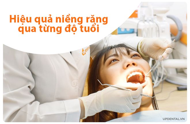 hiệu quả niềng răng qua từng độ tuổi