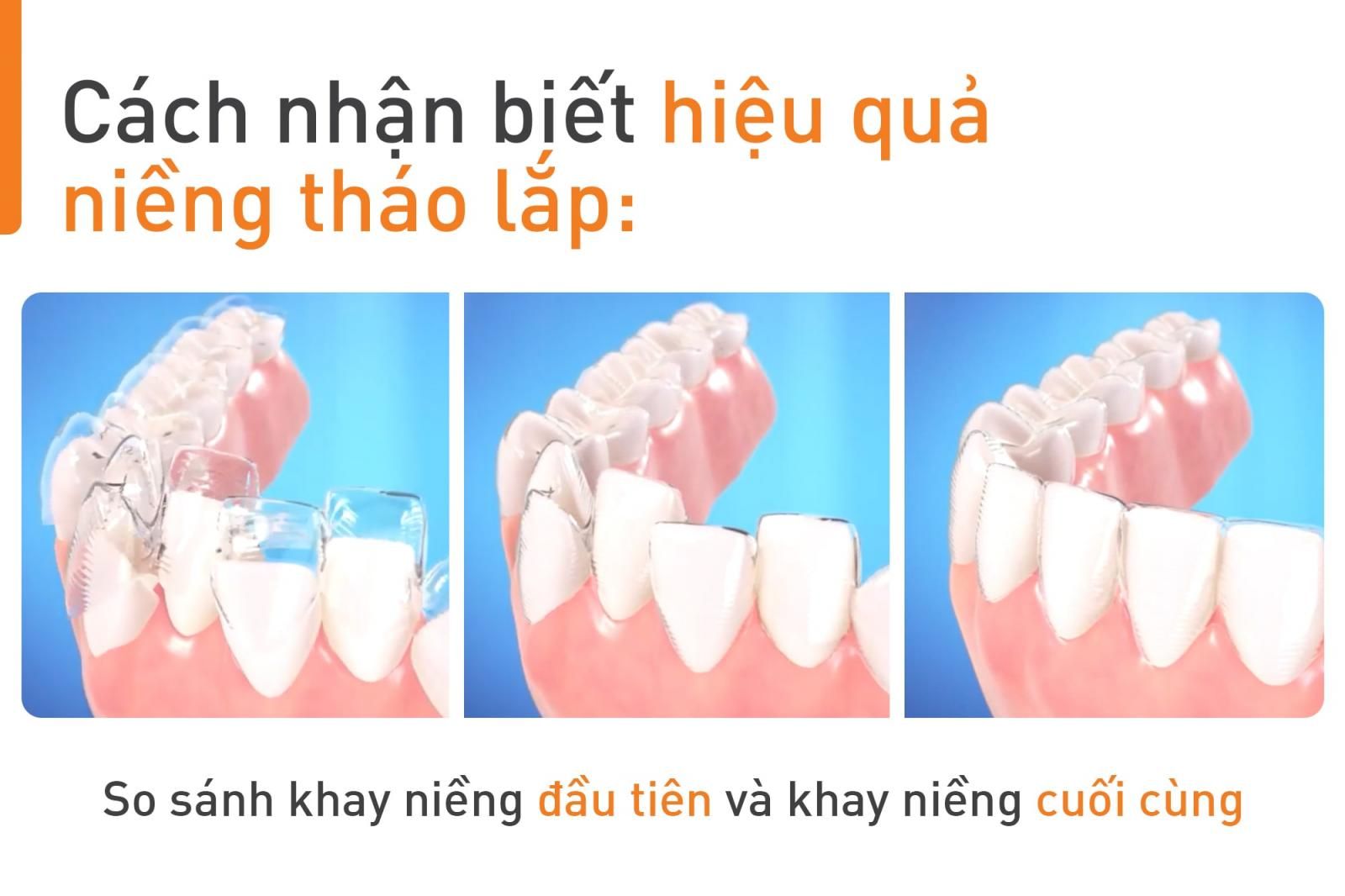 hiệu quả niềng răng tháo lắp