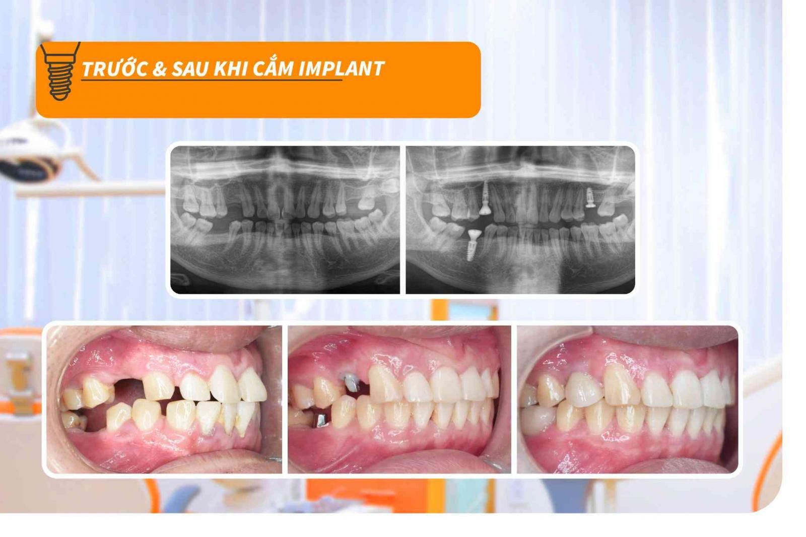 Hình ảnh khách hàng trước - sau khi trồng răng Implant