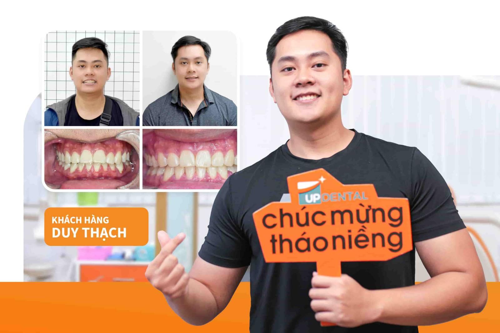 Hình ảnh niềng răng mắc cài sứ Duy Thạch