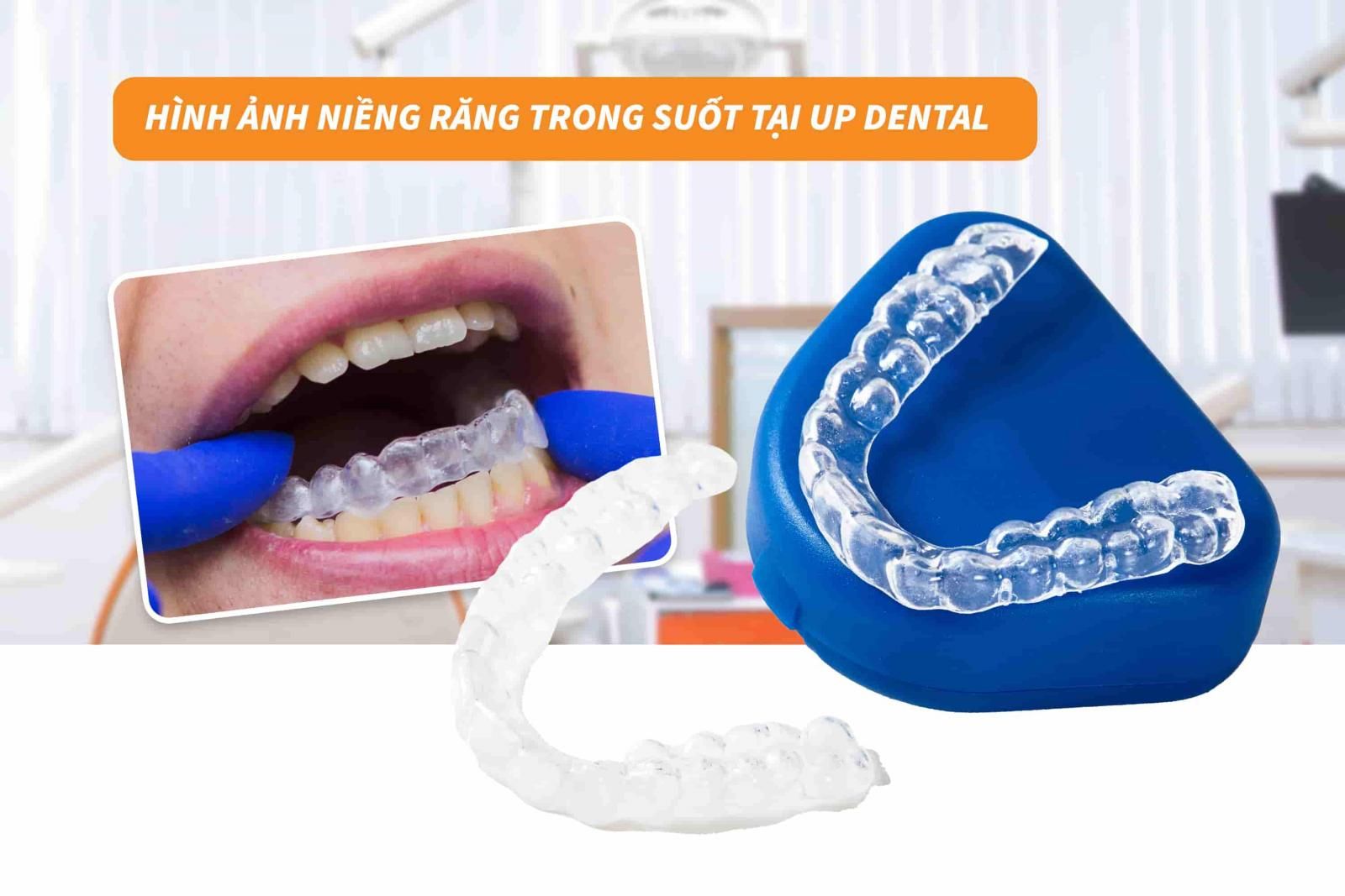 Hình ảnh niềng răng trong suốt tại Up Dental