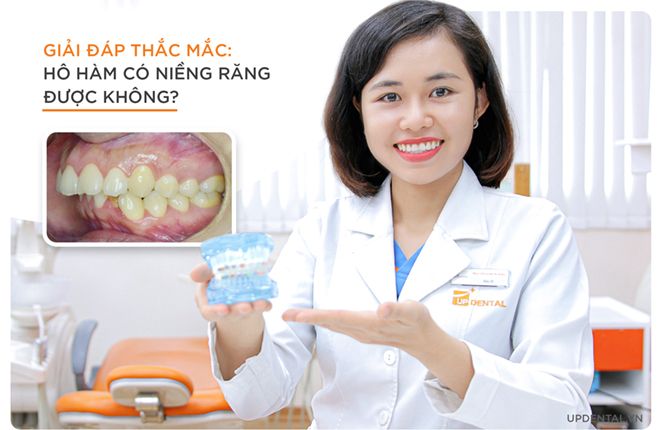 hô hàm có niềng răng được không?