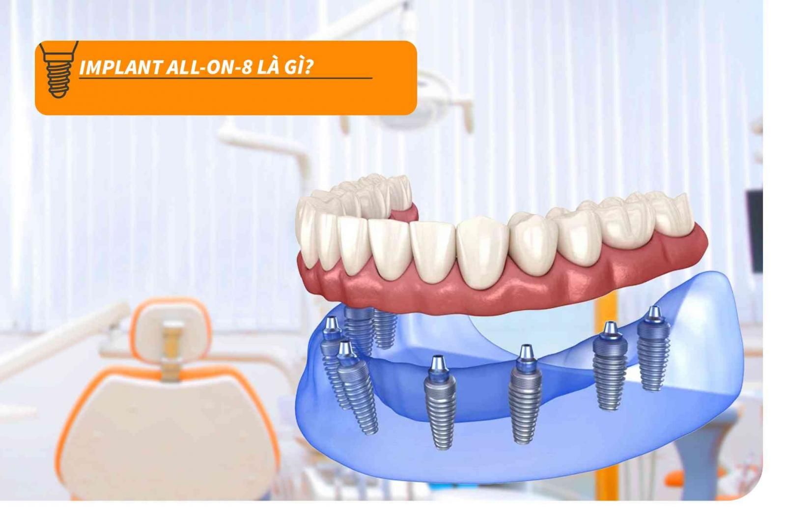 Implant All-on-8 là gì?