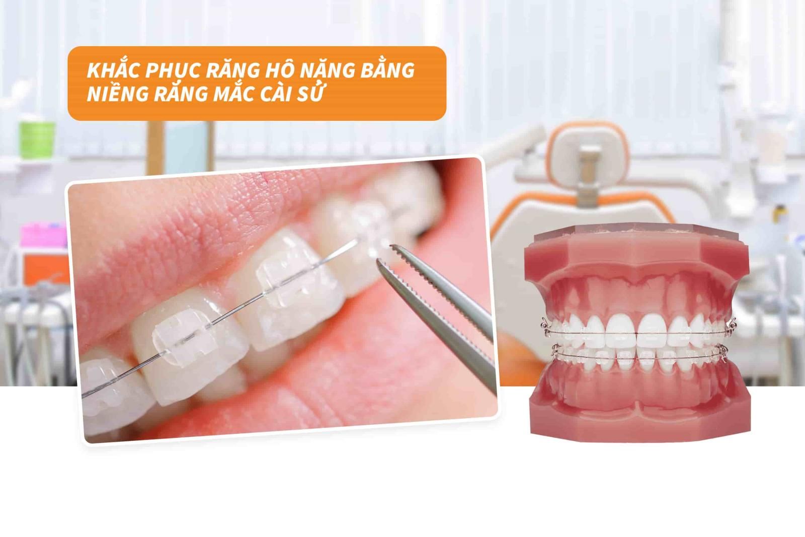 Khắc phục răng hô nặng bằng niềng răng mắc cài sứ