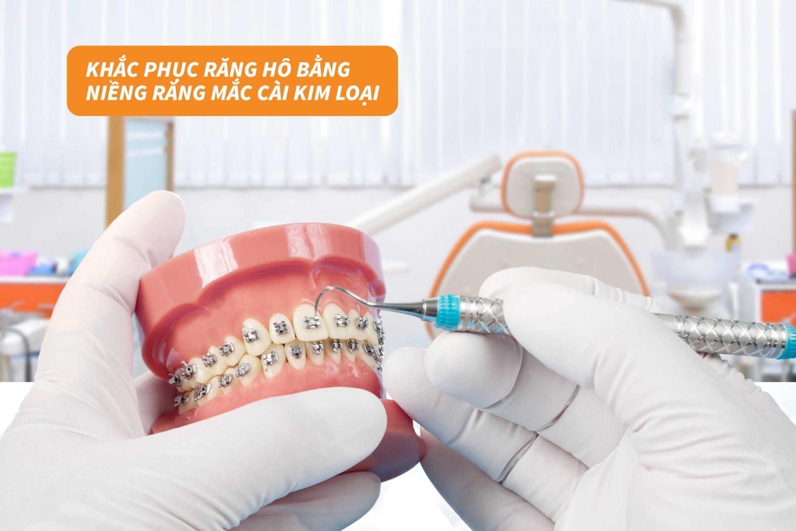 Khắc phục răng hô nặng bằng niềng răng mắc cài kim loại