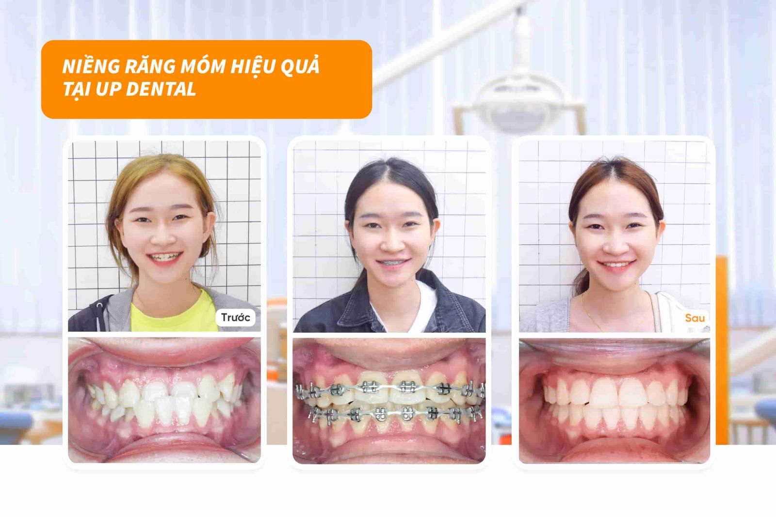 Khách hàng Dương Nhi niềng răng móm hiệu quả tại Up Dental