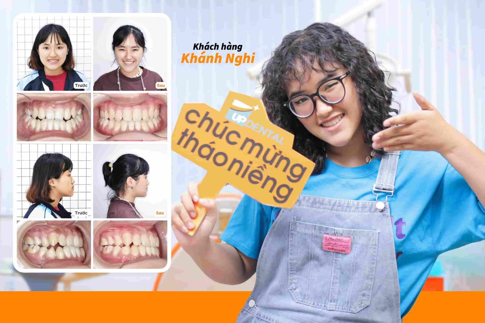 Khách hàng Khánh Nghi niềng răng móm tại Up Dental