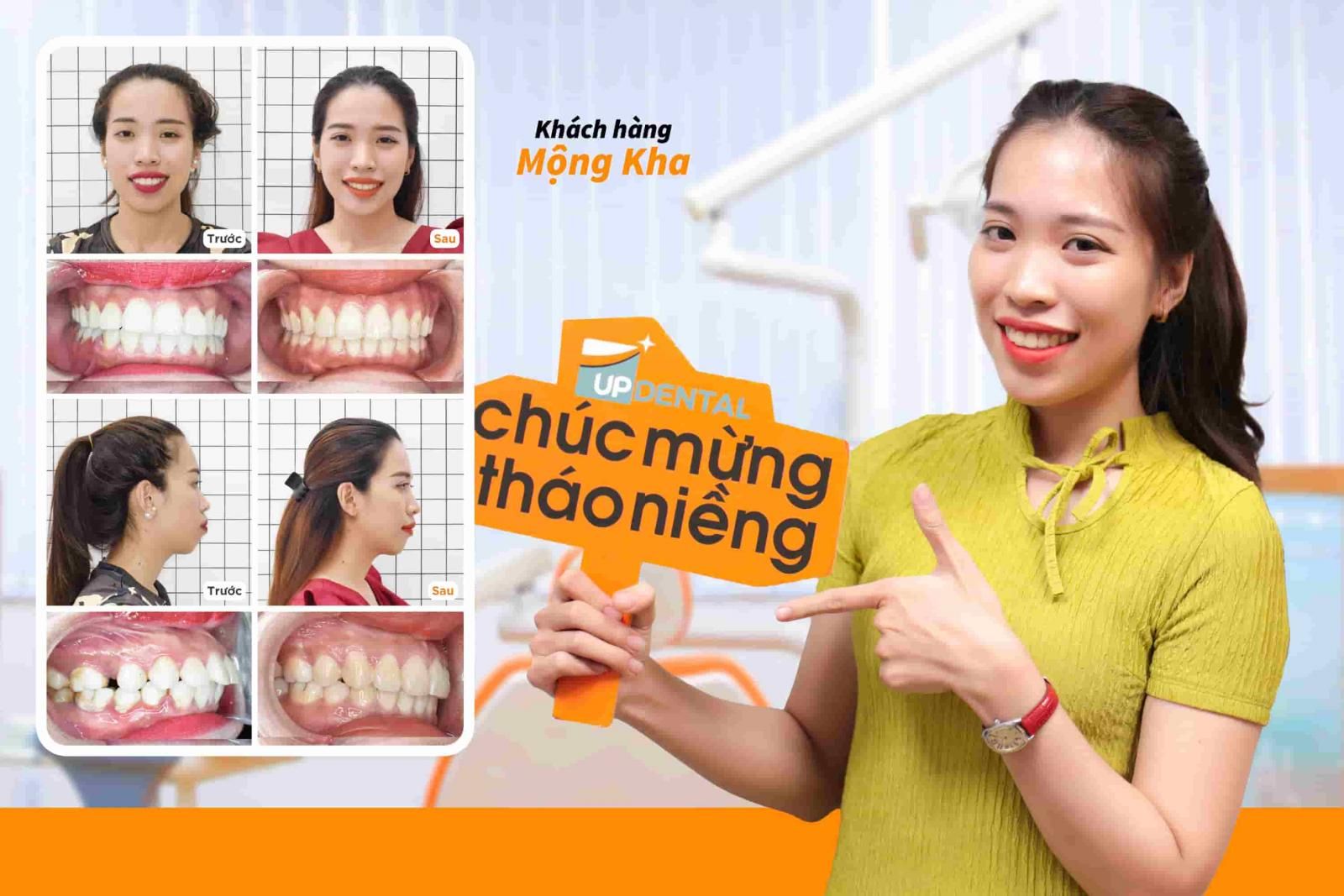 Khách hàng Mộng Kha niềng răng hô tại Up Dental