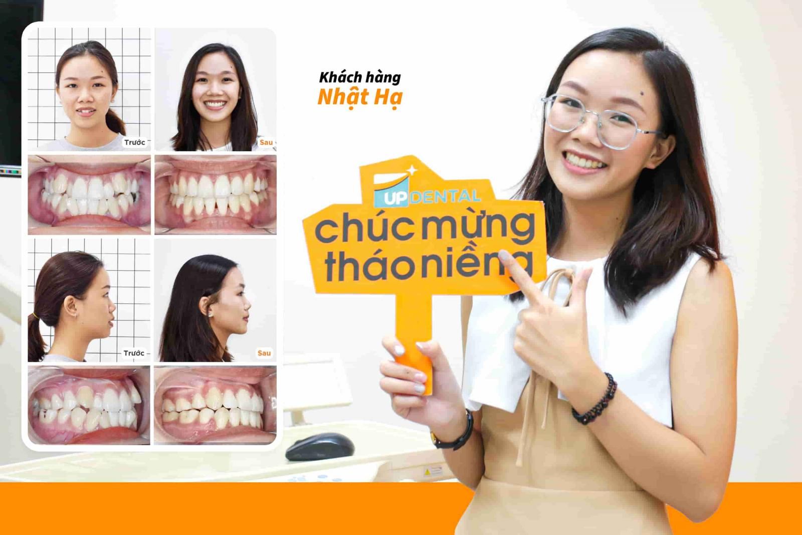 Khách hàng Nhật Hạ niềng răng lệch lạc tại Up Dental