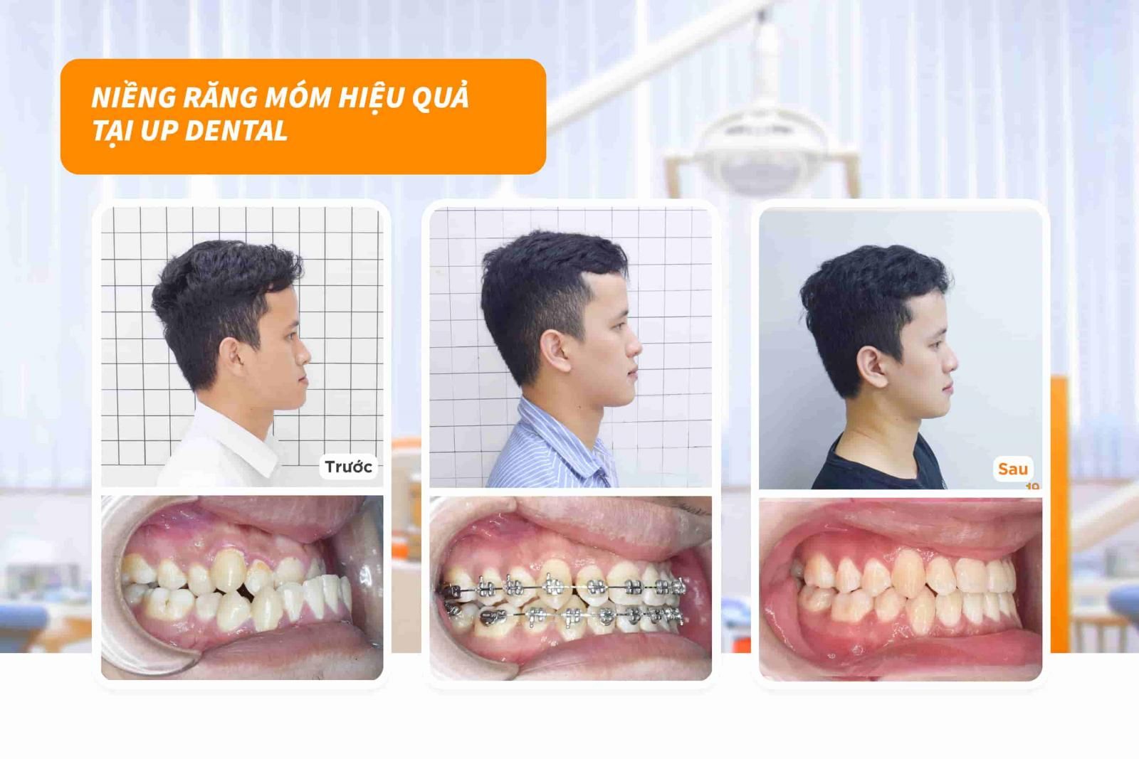 Khách hàng Thế Thanh niềng răng móm hiệu quả