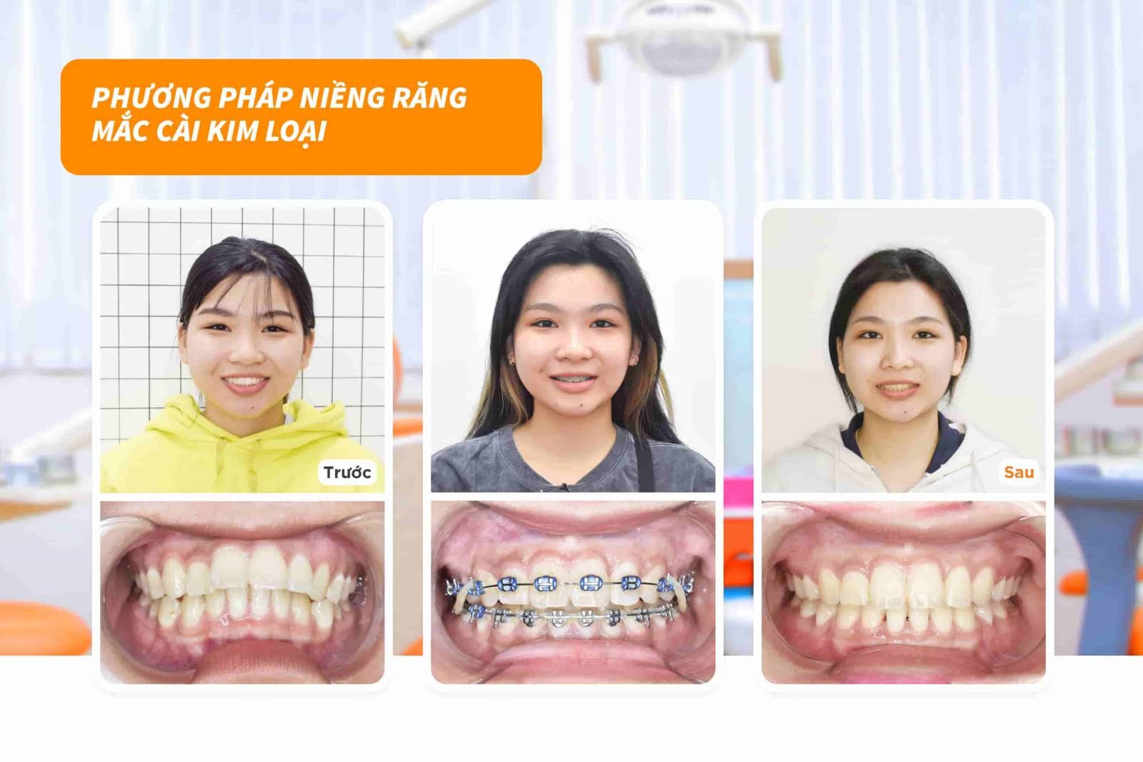 Khách hàng niềng răng mắc cài kim loại thường tại Up Dental