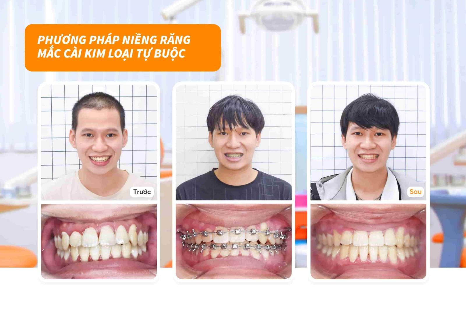 Khách hàng niềng răng mắc cài kim loại tự buộc tại Up Dental