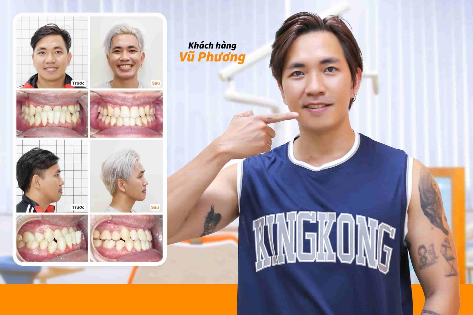 Niềng răng móm tại Up Dental