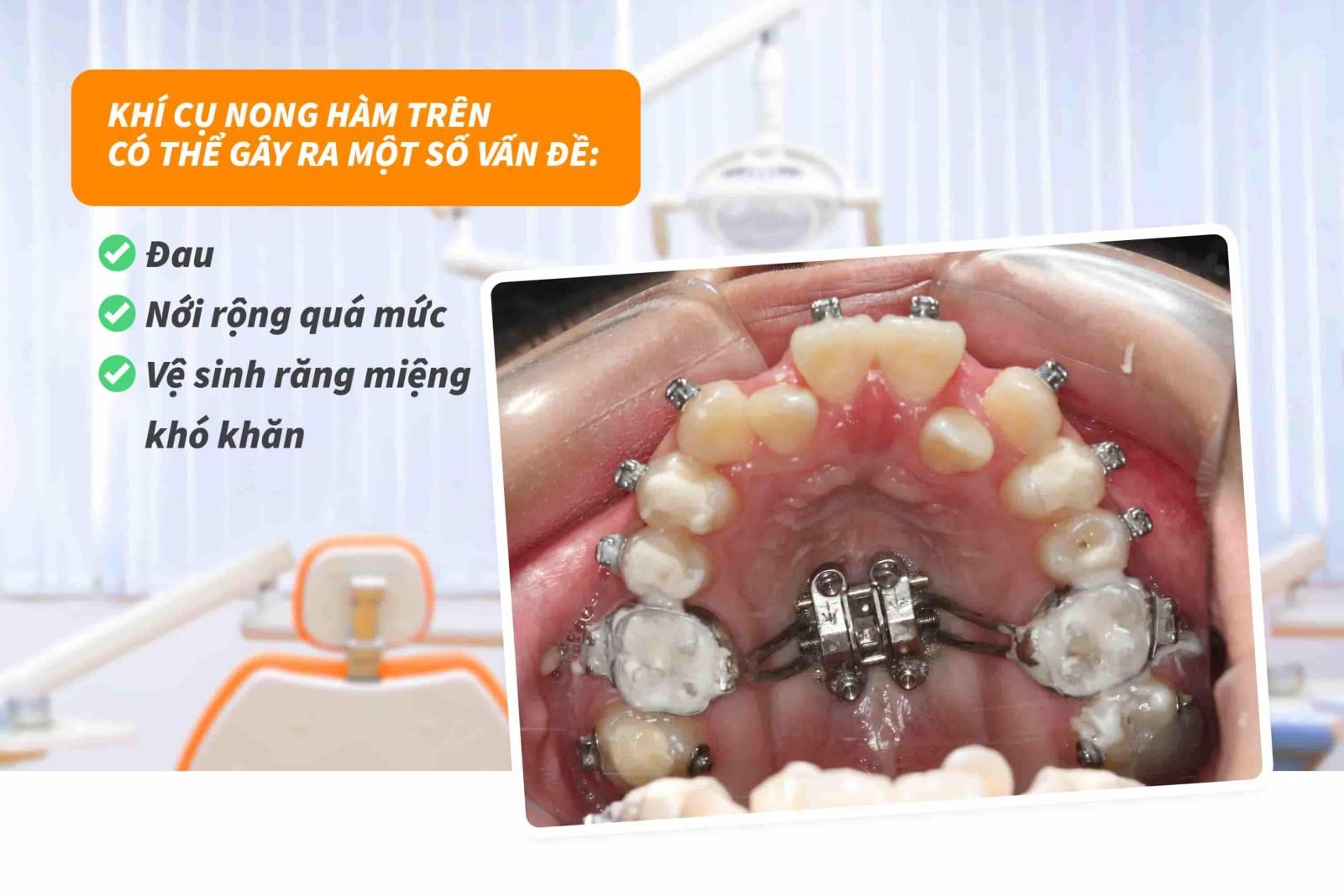 Khí cụ nong hàm trên có gây ảnh hưởng gì không? 