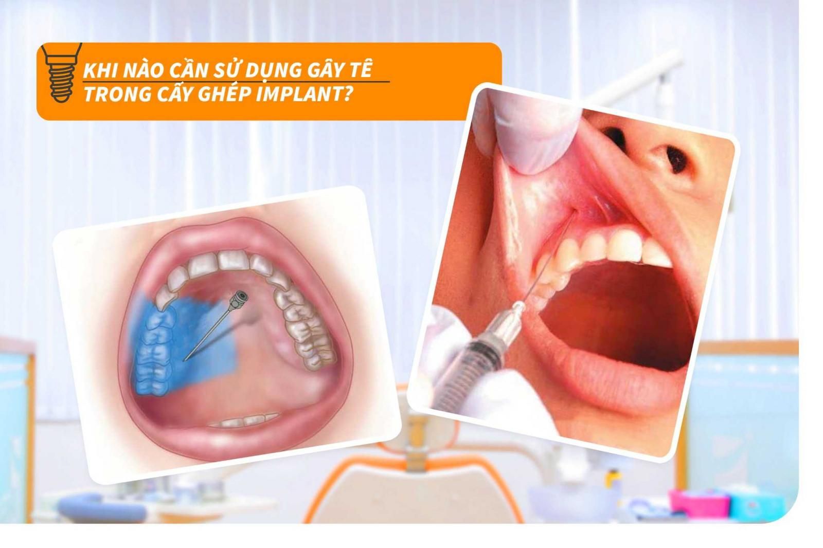 Khi nào cần sử dụng gây tê trong cấy ghép Implant?