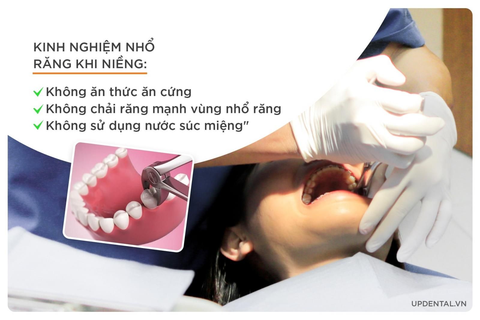 kinh nghiệm nhổ răng khi niềng