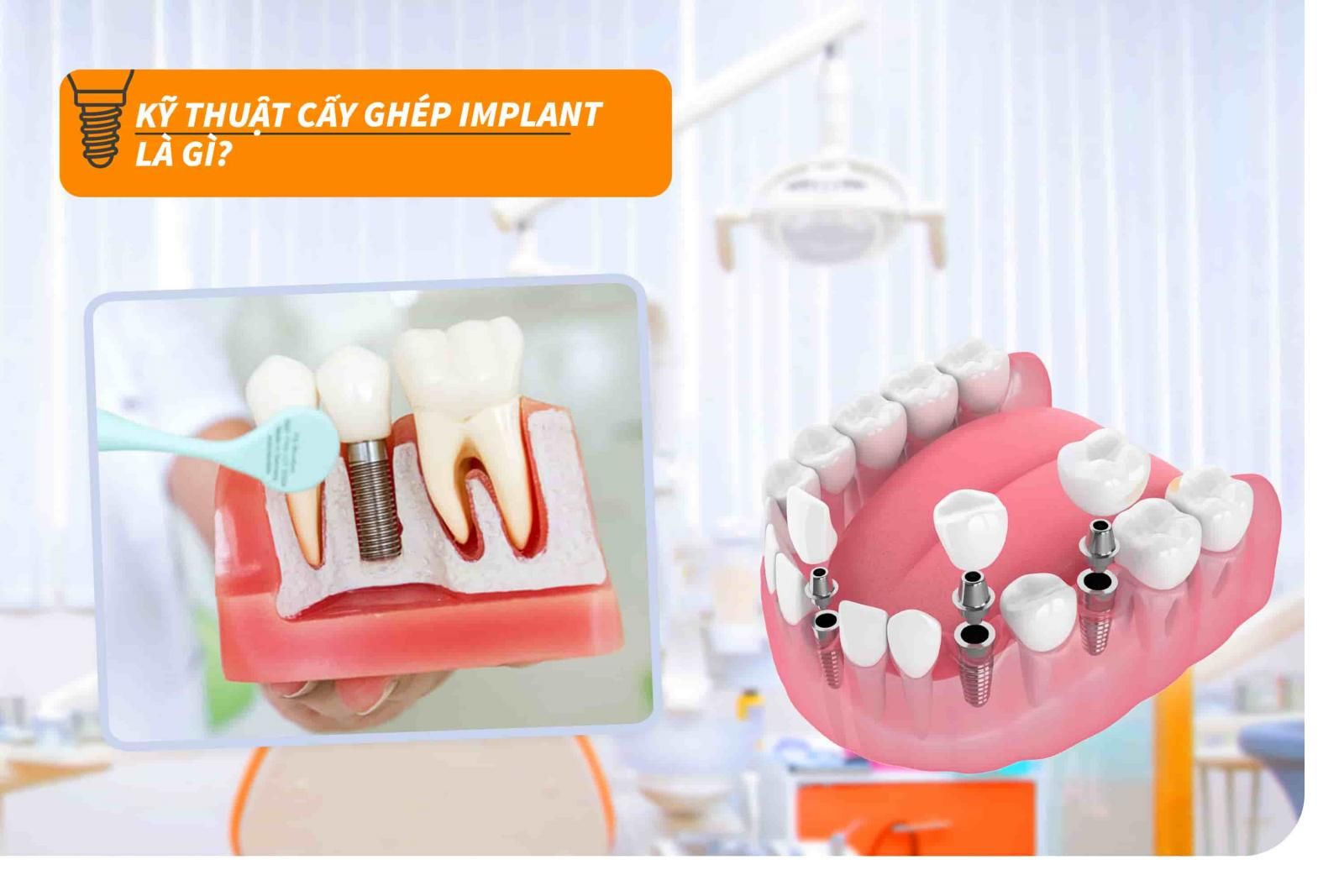 Kỹ thuật cấy ghép Implant là gì?