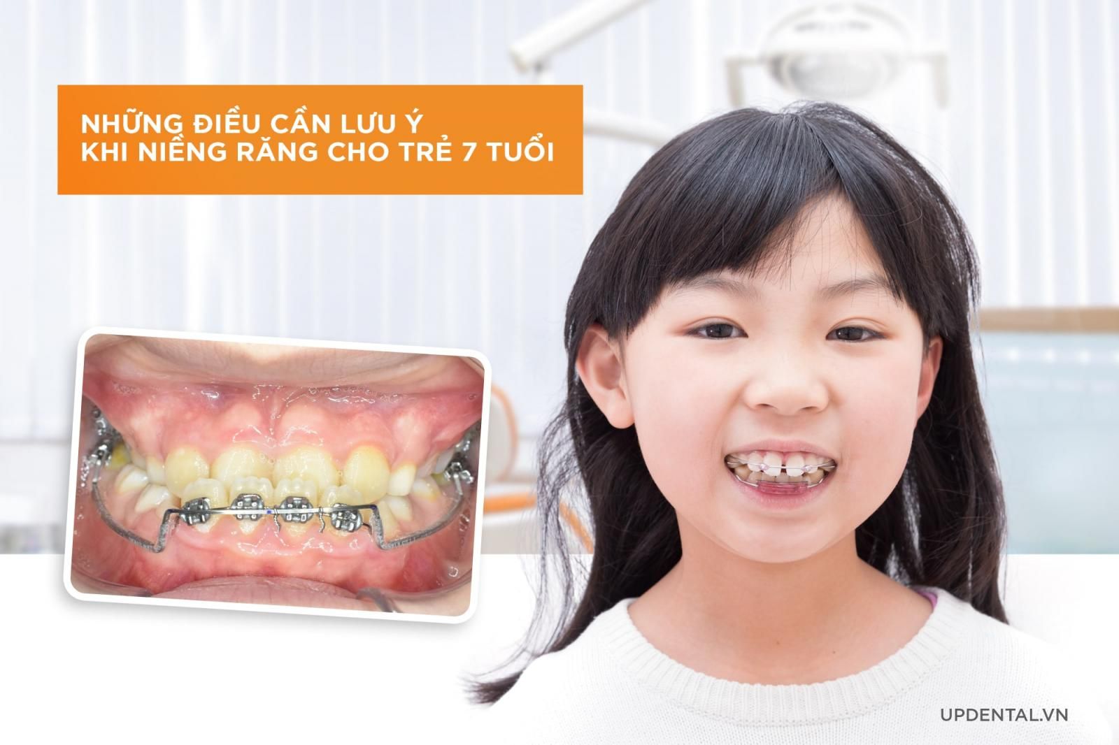 lưu ý khi niềng răng cho trẻ 7 tuổi