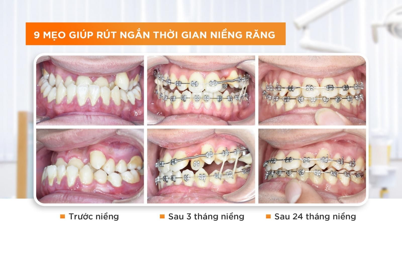 9 mẹo rút ngắn thời gian niềng răng