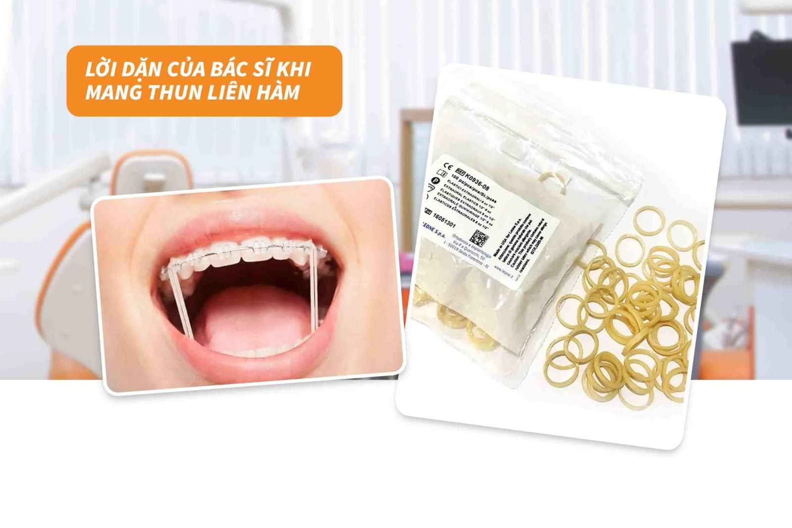 Kinh nghiệm niềng răng 11: Lưu ý khi mang thun liên hàm 