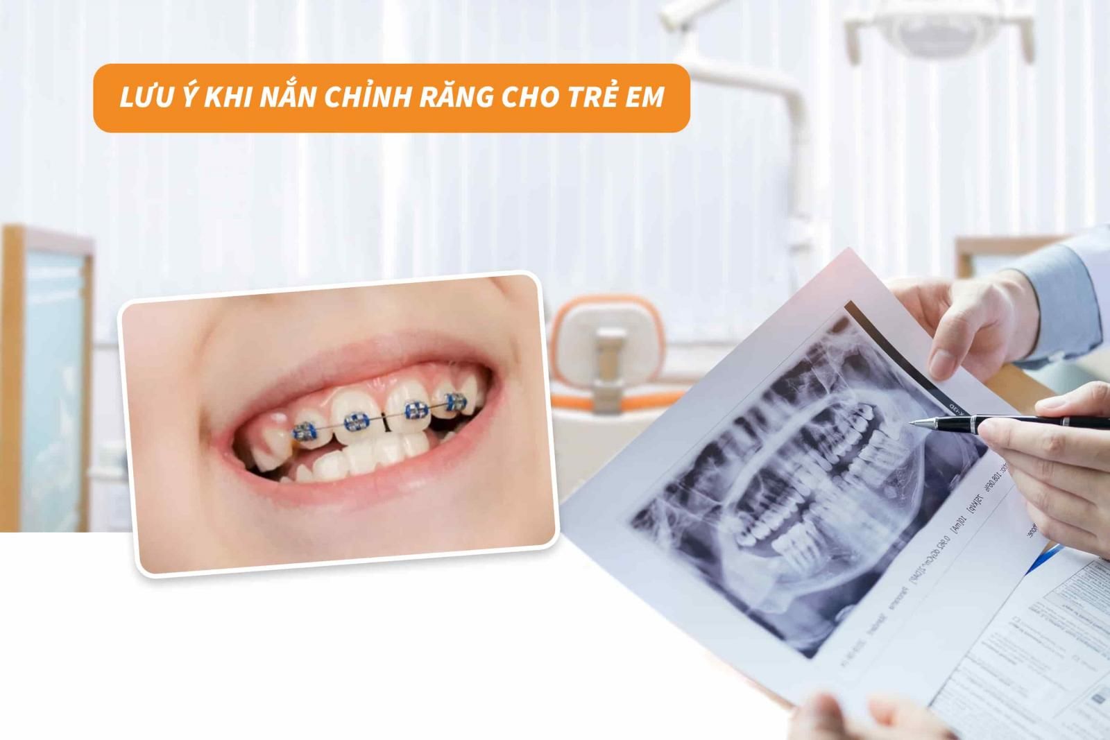 Lưu ý khi nắn chỉnh răng cho trẻ em