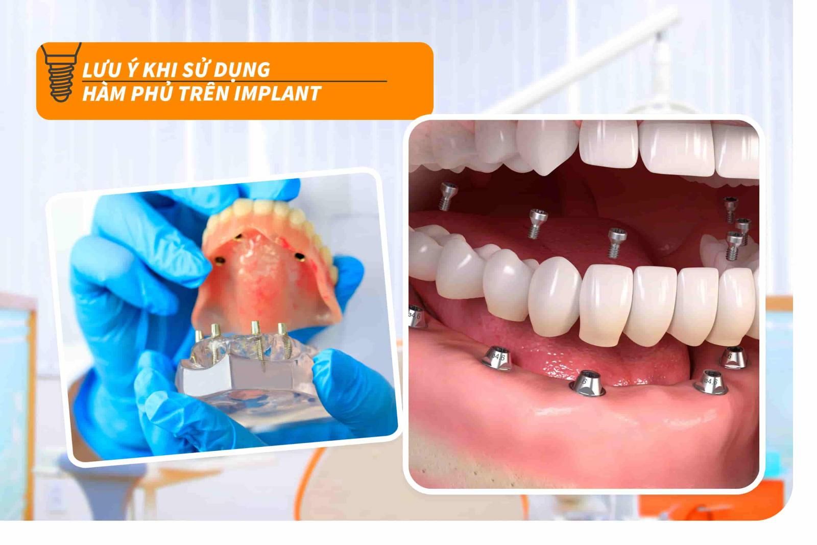 Lưu ý khi sử dụng hàm phủ trên Implant