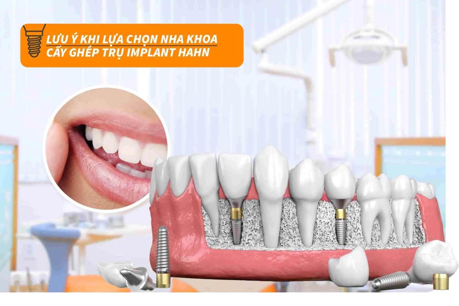 Lưu ý khi lựa chọn nha khoa cấy ghép trụ Implant Hahn